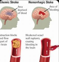 73 years Mithun Da confronts distressing ischemic cerebrovascular stroke