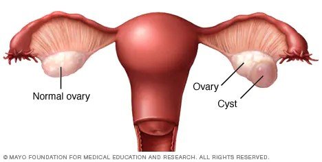 PCOS